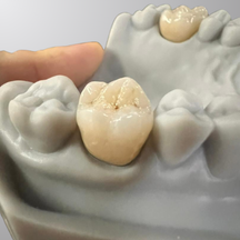 Zirconia Crown and Bridges