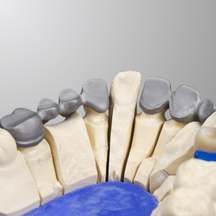 PFM Crown and Bridges