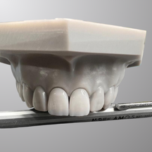 Emax Veneers and Crowns