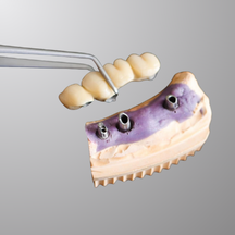 Implants