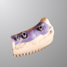 Individual Abutment